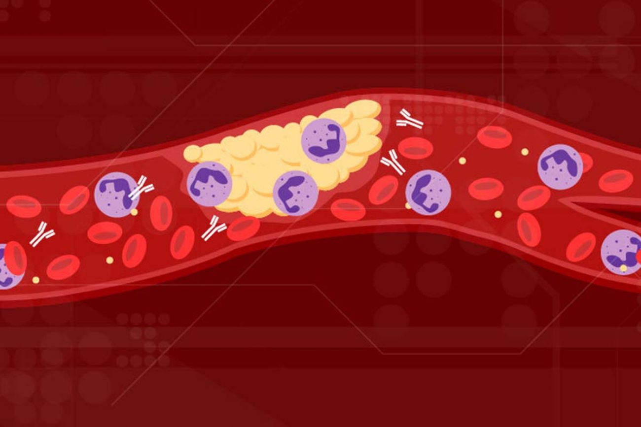 University of Michigan team links 'rogue' antibodies to COVID