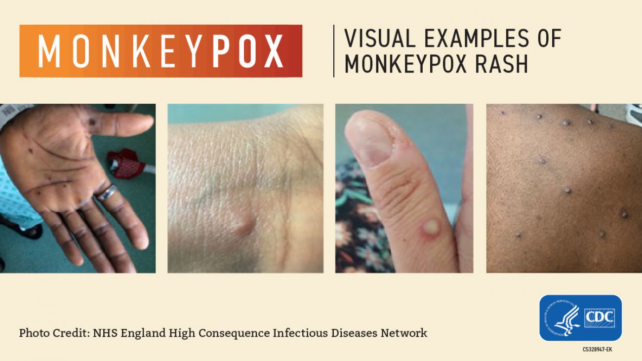 people with monkeypox on hand