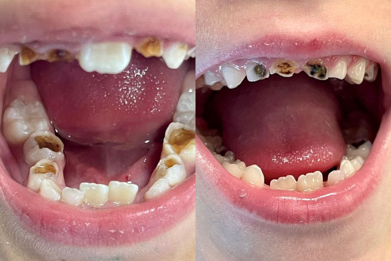 Children's mouths with tooth decay